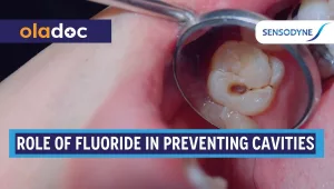 role of fluoride in preventing cavities