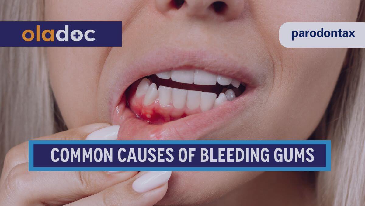 10 Common Reasons Your Gums Might Be Bleeding thumbnail