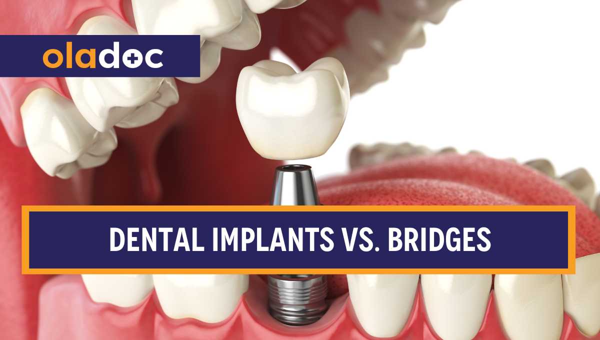 Dental Implants vs. Bridges: Which is Right for You in Pakistan? thumbnail