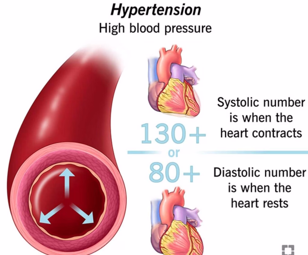 hypertension diagram